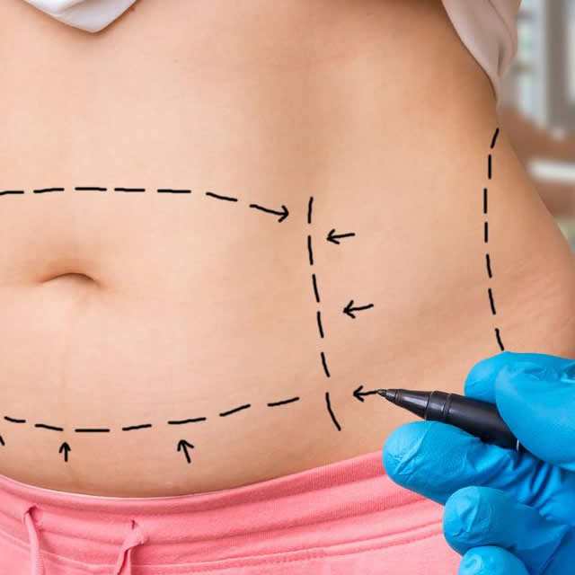 RINOPLASTIA-ULTRASONICA-GUAYAQUIL